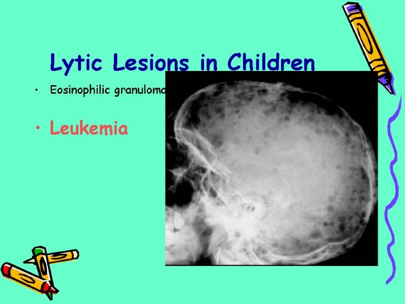 Lytic Lesions in Children Eosinophilic granuloma  Leukemia